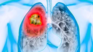 Скільки живуть з водою в легенях: від чого залежить прогноз